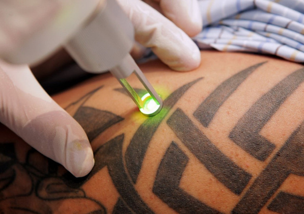 Лазерное удаление татуировки. Видео - 